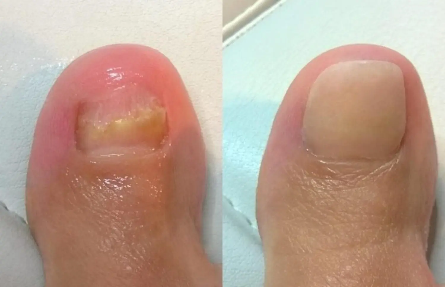 Podologie Yurttas - vor und nach der Nagelpflege