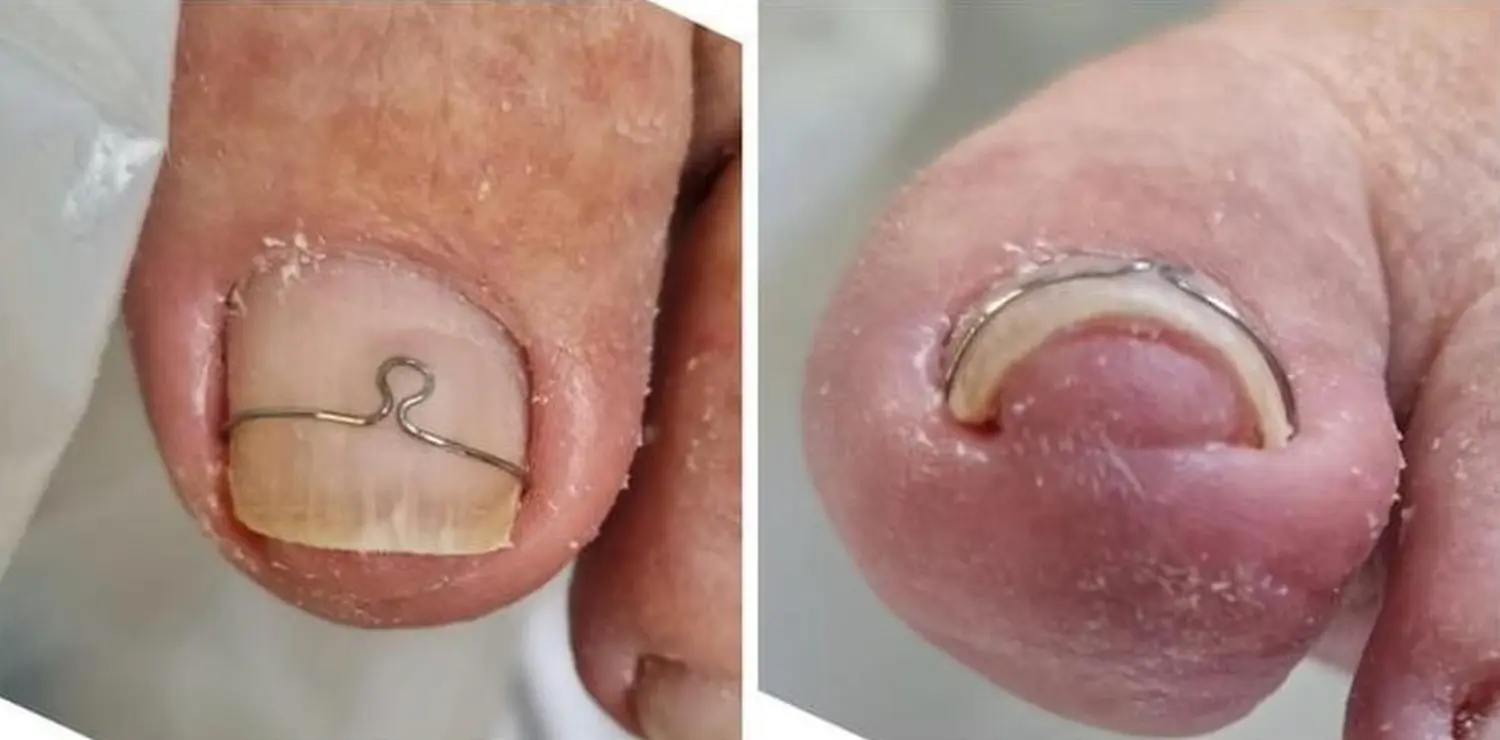 Podologie Yurttas - Fußbehandlung Nageldrähte