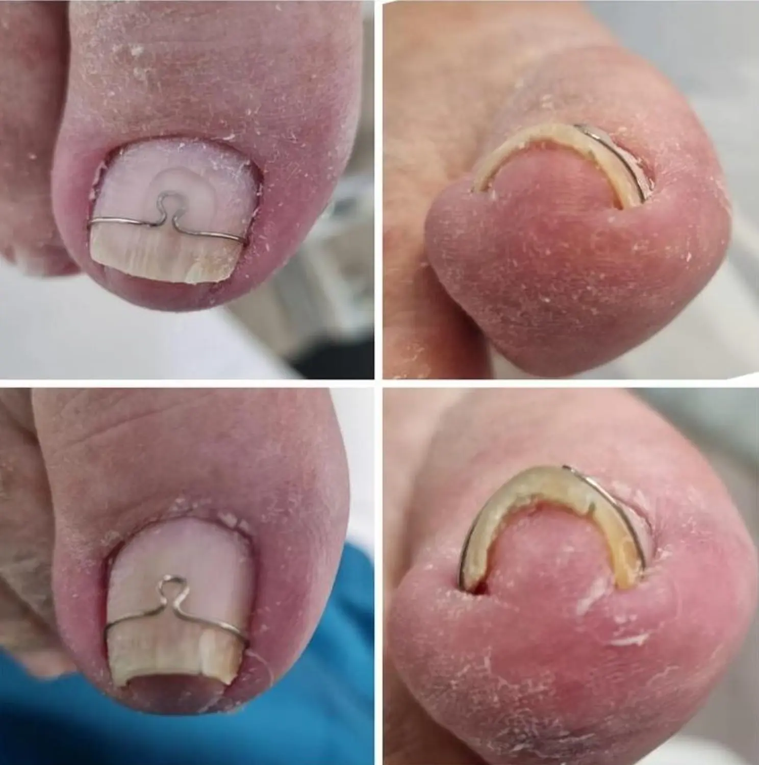 Podologie Yurttas - Fußbehandlung Nageldrähte